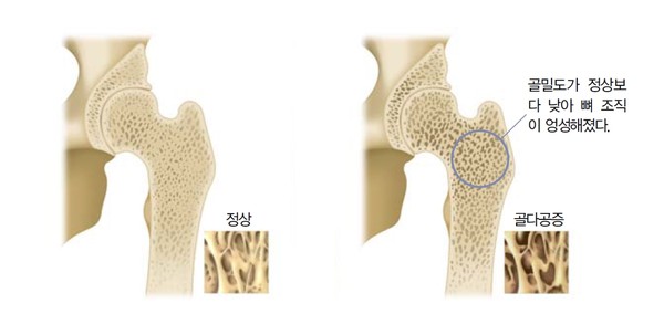 정상 뼈(왼쪽)와 골다공증이 있는 뼈(오른쪽)